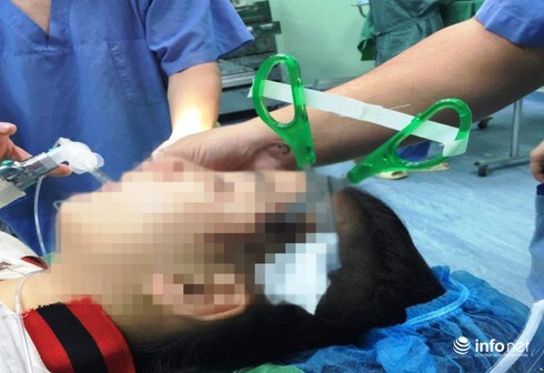 Nghệ An: Cứu sống bé gái bị bạn găm kéo nhọn vào đầu sâu 3cm