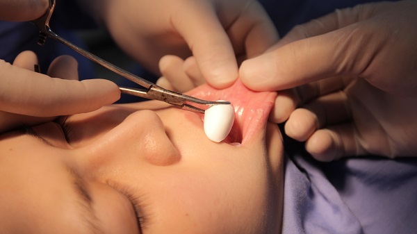 Độn cằm V-Line – Sở hữu gương mặt thanh tú chỉ sau một lần phẫu thuật 