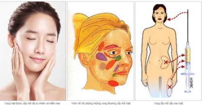 Làm đầy má hóp trẻ hóa gương mặt chỉ 30 phút