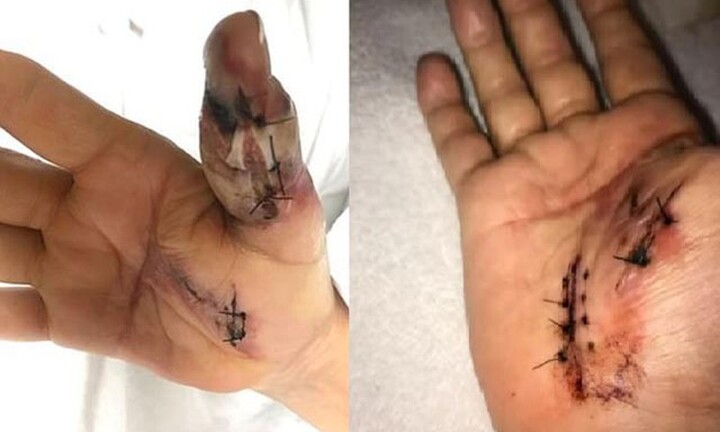 Chỉ đi làm móng mà cũng khiến tay biến dạng, suýt chết