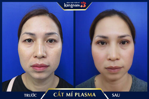 “Giải cứu” đôi mắt sụp mí, bọng mắt chỉ sau 30 phút