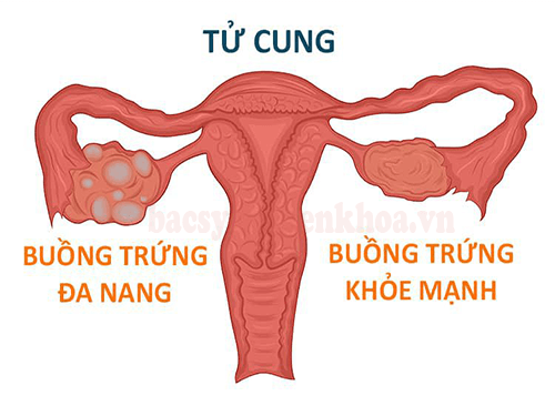 Chuyên gia y tế giải đáp: Đa nang buồng trứng nên ăn gì?