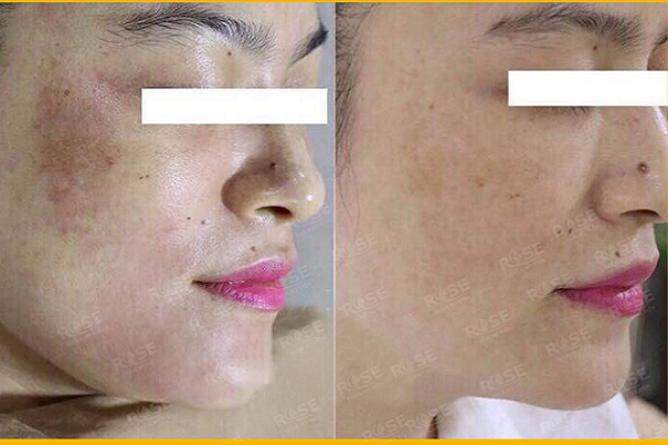 Trị nám sao cho hiệu quả và an toàn?