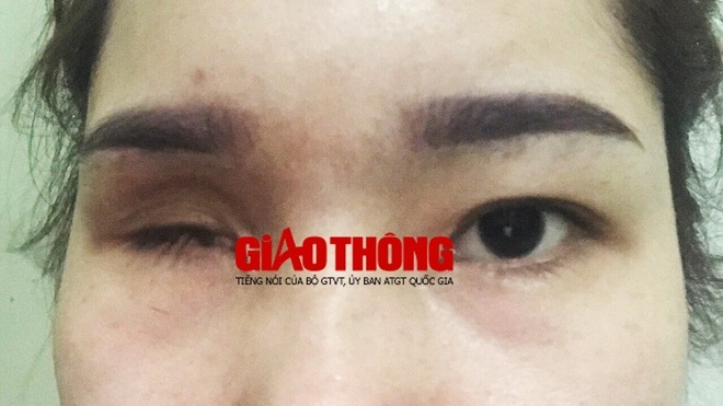 Cô gái mù vĩnh viễn một bên mắt vì nâng mũi bằng chất làm đầy