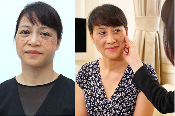 Bí kíp trị nám, tàn nhang hiệu quả giúp kéo dài tuổi xuân