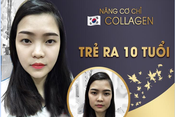 Tại sao mọi người lại chọn nâng cơ chỉ Ultra Korea Collagen tại TMV Quốc tế Bắc Âu