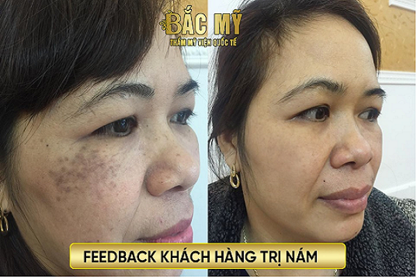 Công nghệ Laser Picosure tại TMV quốc tế Bắc Mỹ mang đến kết quả mong đợi