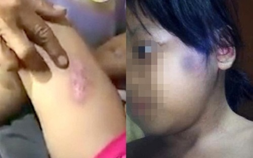 TP.HCM: Bắt khẩn cấp đối tượng đánh đập, châm tàn thuốc lá vào con riêng của vợ 