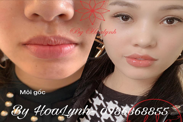 Tiêm filler có ảnh hưởng gì đến sức khỏe không?