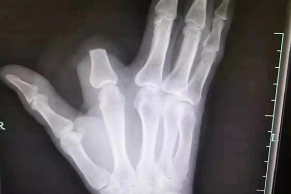Bị rắn độc cắn, người đàn ông Trung Quốc chặt phăng ngón tay của mình
