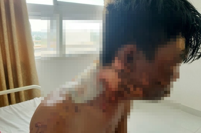 Điều tra vụ nam thanh niên tố bị chị ruột đổ nước sôi vào đầu
