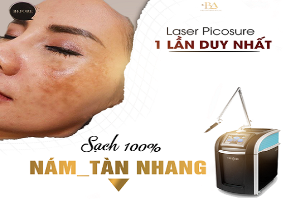 Chấm dứt nám đeo bám sau 7 năm bằng công nghệ Laser Picosure tại thẩm mỹ viện quốc tế Bắc Âu