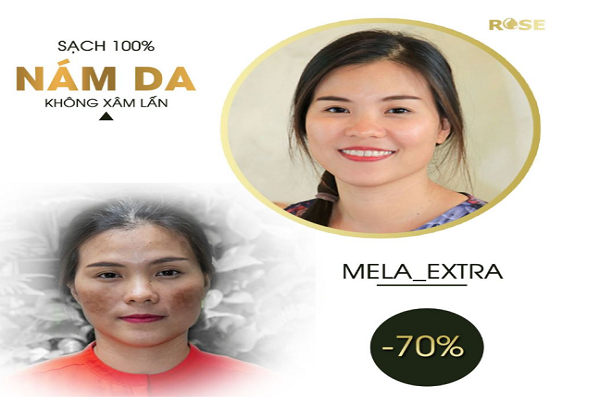 Thẩm mỹ viện Rose cầu giấy trị nám 1 lần duy nhất cam kết hiệu quả