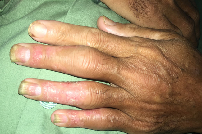 Uống thuốc nam chữa vẩy nến, khớp biến dạng,