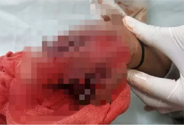 Đèn pin phát nổ khi sạc, bé 9 tuổi phải cắt bỏ bàn tay