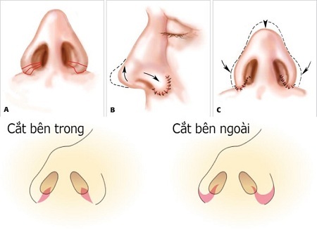 Thu gọn cánh mũi chỉ mang lại hiệu quả “khi và chỉ khi”