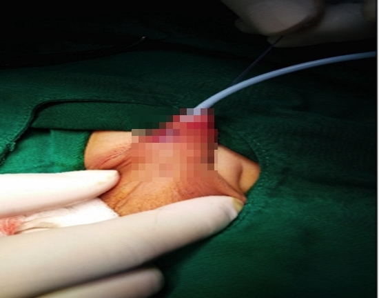 Bé trai 5 tuổi bị mắc rò niệu đạo hiếm gặp, bệnh lý hay di truyền