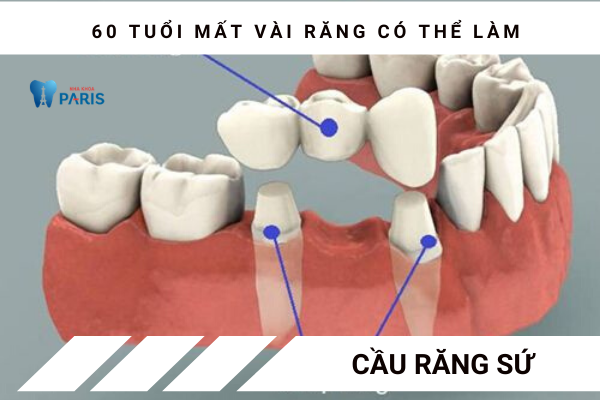 60 tuổi mất răng nên bắc cầu răng hay làm Implant?