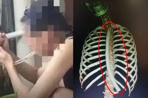 Học mẹo giảm cân trên mạng, cô gái gặp cái kết nhớ đời