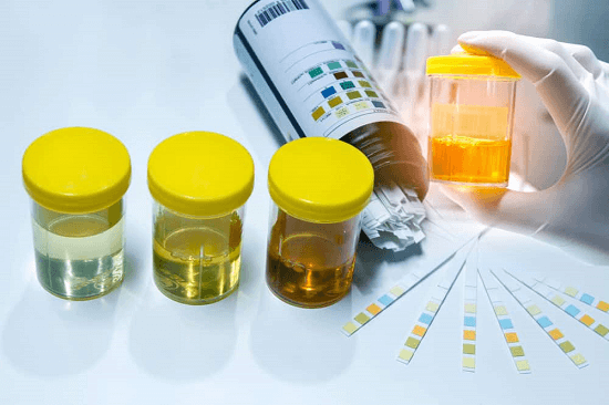 Tổng hợp các thông tin quan trọng về xét nghiệm tổng phân tích nước tiểu
