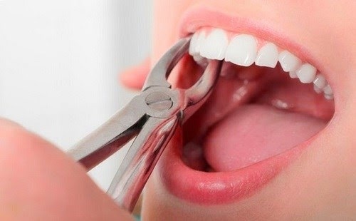 10 câu hỏi được nhiều người quan tâm nhất khi niềng răng