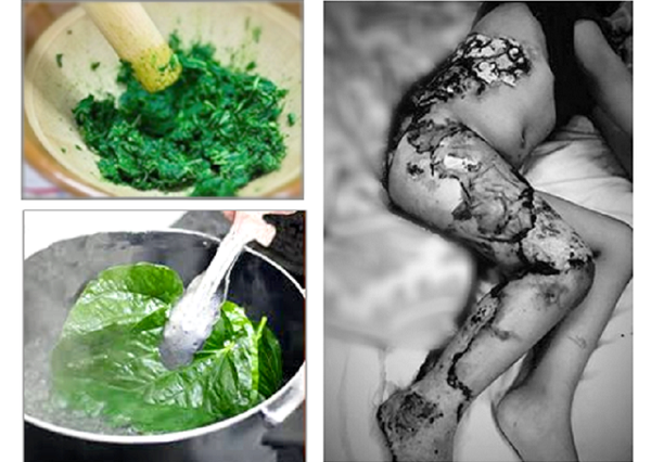 Điều trị bỏng bằng lá cây, bé 15 tháng tuổi chết tức tưởi