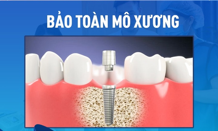 Trồng implant xong có niềng được không?