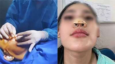 Nâng mũi nhiễm trùng, thiếu nữ bị spa sửa thành biến dạng