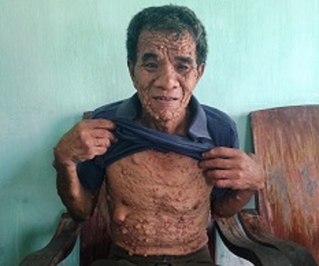 Nỗi đau của người lính già mắc bệnh lạ