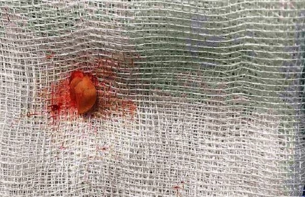 Cứu nguy bé gái 3 tuổi hóc hạt đậu phộng suốt 2 tháng