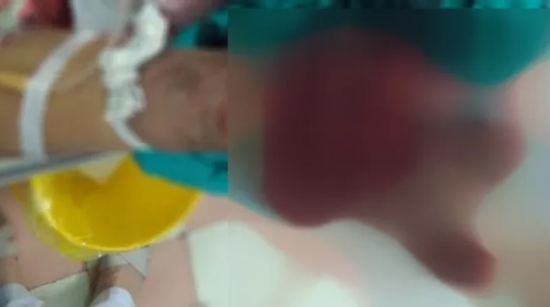 Hải Dương: Lên Youtube học làm pháo tự chế, nam sinh 15 tuổi dập nát cẳng bàn tay phải