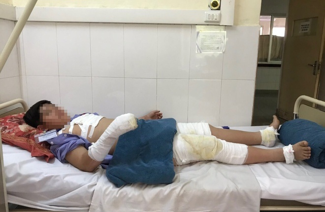 Nghịch dại với cồn, bé trai 11 tuổi nguy cơ mất chơi Tết vì bỏng nặng