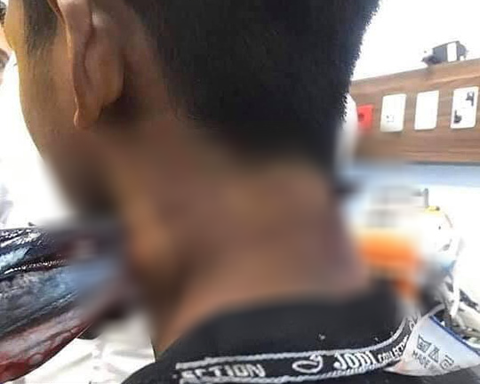 Đang ngồi trên thuyền, thiếu niên bất ngờ bị cá nhảy lên đâm xuyên cổ