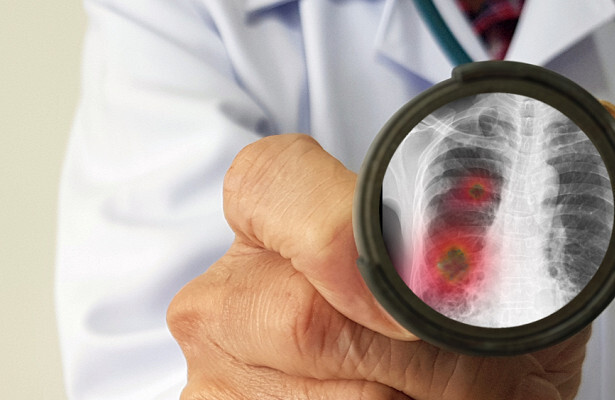 Chuyên gia Nga nêu triệu chứng tổn thương nguy hiểm nhất do virus corona mới gây ra