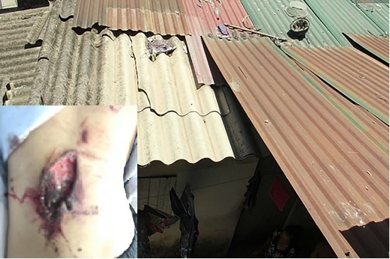 Nam Định: Bị tôn văng vào lưng, bé gái phải đi cấp cứu