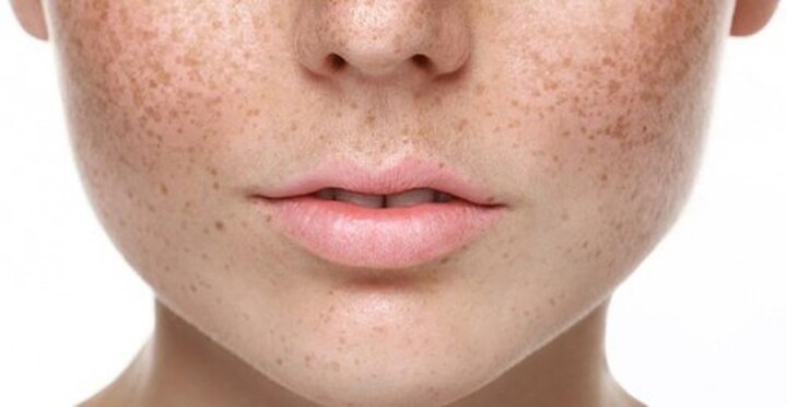Nám Da là gì? Nguyên nhân và địa điểm điều trị Nám Da hàng đầu hiện nay