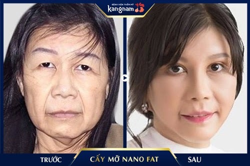 U40-50 da căng bóng đẹp như thuở đôi mươi