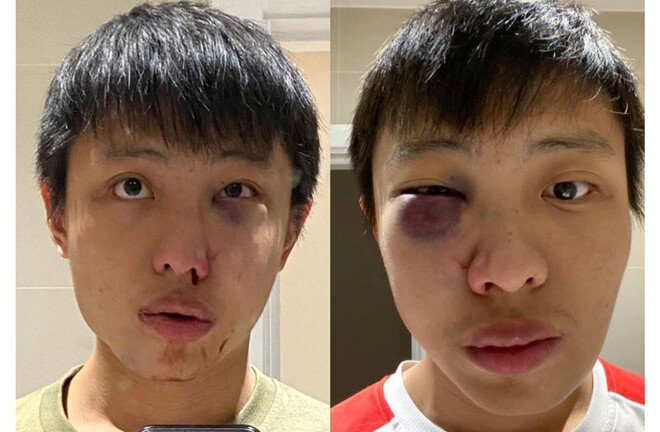 Hé lộ hình ảnh kẻ đánh du học sinh người Singapore bầm dập, gẫy xương mặt vì virus Covid-19