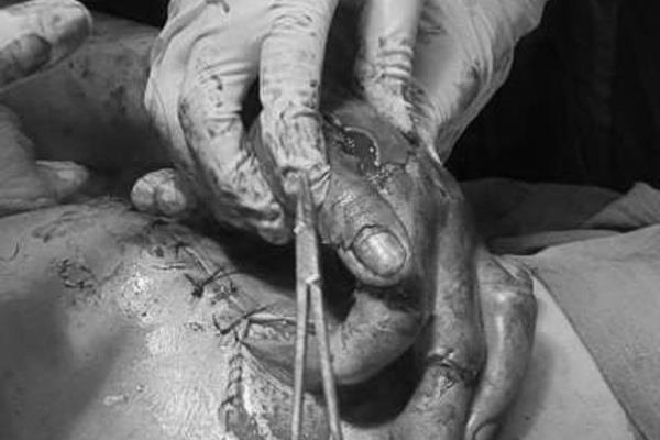 Đốt pháo tự chế, thiếu niên 15 tuổi suýt bị cắt bỏ bàn tay