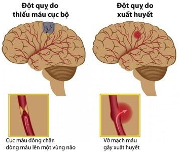 Đột quỵ và những hệ lụy đối với sức khỏe của bạn! 