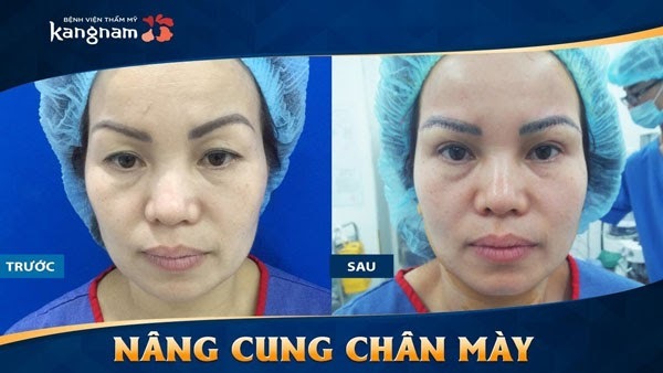 Nâng cung mày – Giải pháp xua tan nỗi lo xệ chân mày