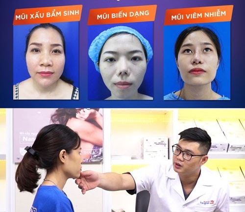 Dậy sóng dáng mũi Sline thời 4.0 khiến chị em 