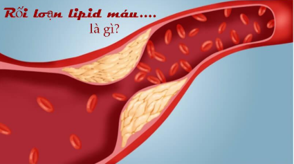 Lipidcleanz giúp bạn cải thiện rối loạn lipid máu hiệu quả!