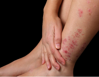 Bật mí nguyên nhân và cách điều trị bệnh vảy nến ở chân