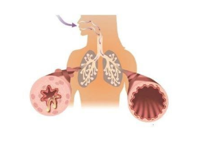 Tại sao Bảo Phế Vương lại giúp cải thiện hiệu quả tình trạng ho lâu ngày uống kháng sinh không khỏi? 