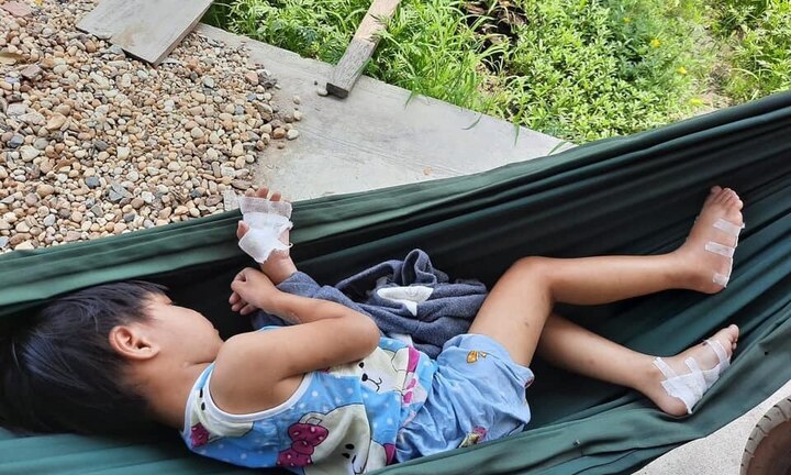 Tạm giữ gã cha dượng dí tay của bé gái 4 tuổi vào pô xe máy