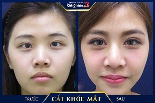 30 phút biến mắt nhỏ 