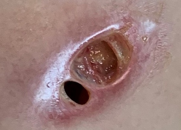 Tin tức đời sống mới nhất ngày 27/4/2020: Ngực thủng lỗ sâu hoắm vì tiêm silicon ‘nâng cấp vòng 1’