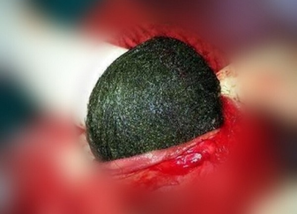 Tin tức đời sống mới nhất ngày 28/4/2020: Sụt cân, chán ăn vì búi tóc to bằng quả bưởi ở trong bụng