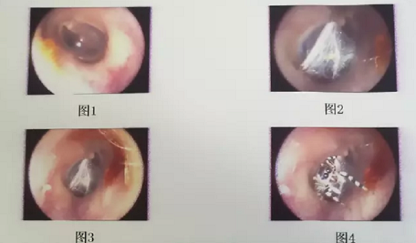 Tin tức đời sống mới nhất ngày 30/4/2020: Nhện sống trong ống tai người phụ nữ